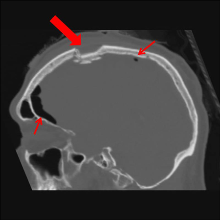 Sagittal CT images of an open, comminuted, depressed skull fracture. Note the associated pneumocephalus (small arrows). The level of depression is greater than the bony table and there are several bone fragments impacted below the inner cortex of the opposing bone (large arrow). Despite lack of underlying associated brain injury this fracture required operative debridement and elevation of the bone fragments. See also the corresponding coronal CT image