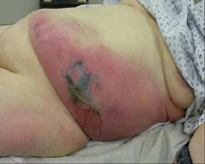 Necrotizing fasciitis images