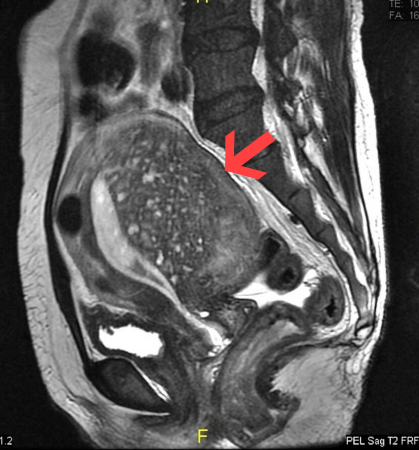 Adenomyosis images