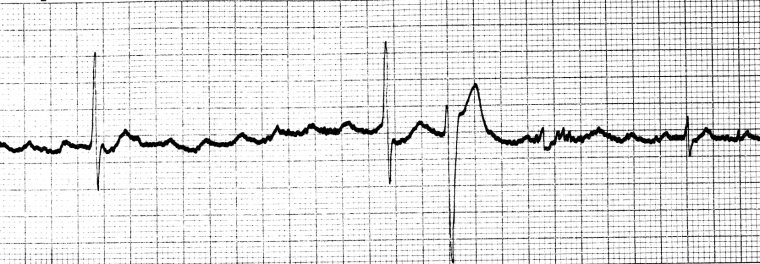 Digoxin toxicity images