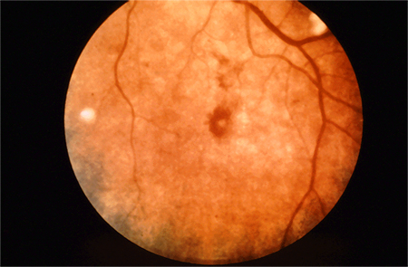 Infective endocarditis images