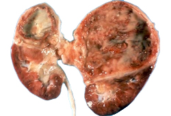 Acute pyelonephritis images