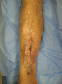 Osteomyelitis images