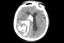 Hemorrhagic stroke images