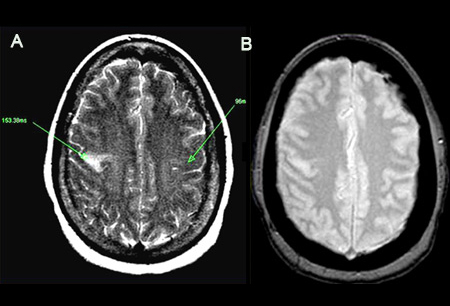 Ischemic stroke images