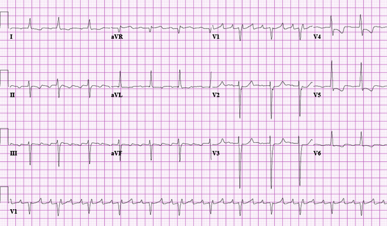Typical atrial flutter with variable (3 to 4:1) block