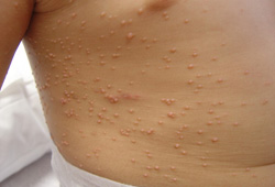 molluscum contagiosum in children