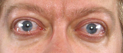 Graves' disease - Symptoms, diagnosis and treatment | BMJ Best Practice