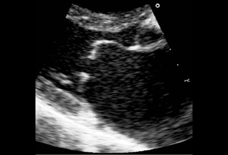 Mitral stenosis images