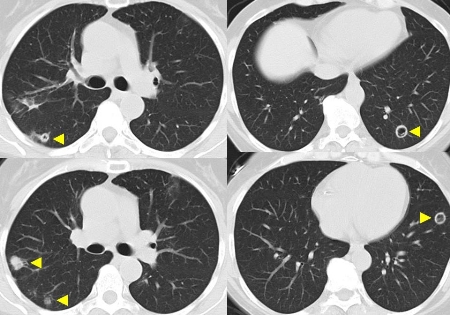 Granulomatosis with polyangiitis images