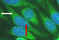 Primary biliary cholangitis images