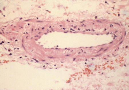 Polyarteritis nodosa images