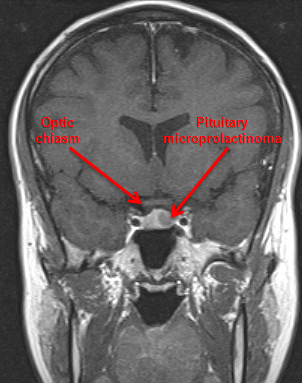 Prolactinoma - Symptoms, Diagnosis And Treatment | BMJ Best Practice