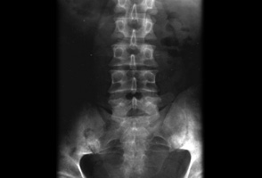 Ankylosing spondylitis images