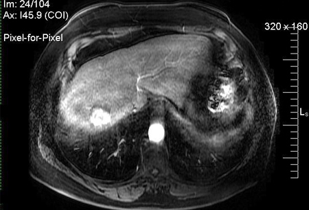 Hepatocellular carcinoma images