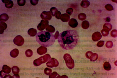 Myelodysplastic syndrome images