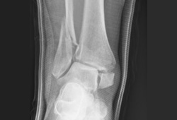 Ankle fractures images