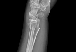 Wrist fractures images
