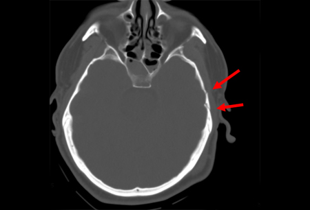 simple skull fracture