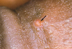 Lymphogranuloma venereum images