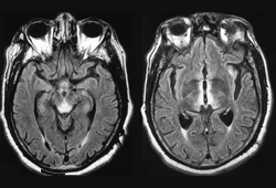 Wernicke encephalopathy images