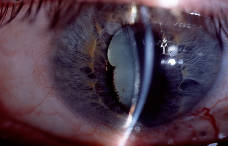 Uveitis images