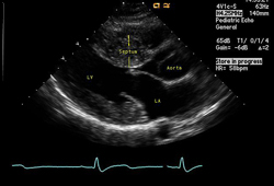 Hypertrophic cardiomyopathy images