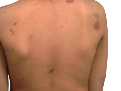 Neurofibromatose do tipo 1 images