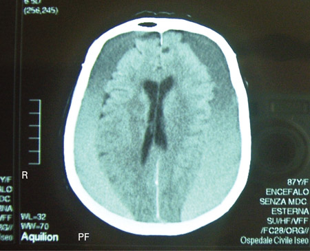 Subdural hematoma images