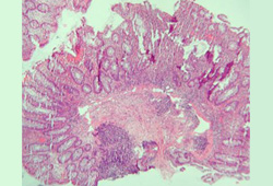 Crohn disease images