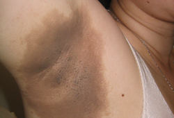 aksilla bölgesindeki cilt koyulaşması olduğuna Kadın Genital Bölge Kararması Vulvar Acanthosis Nigricans araştırılmalıdır