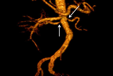 Renal artery stenosis images