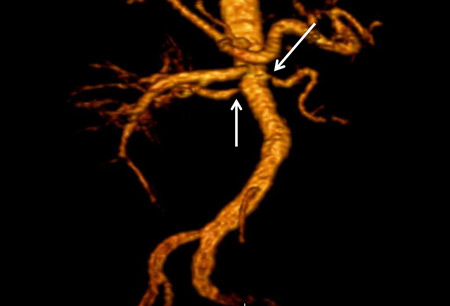 Estenose da artéria renal images