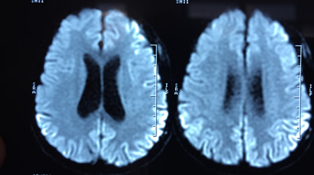 Encephalitis - Investigations | BMJ Best Practice US