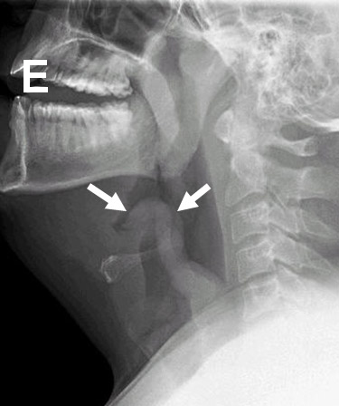 Epiglotite images
