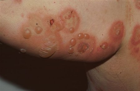 Bullous pemphigoid images