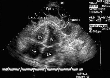 Evaluation of pericardial effusion images