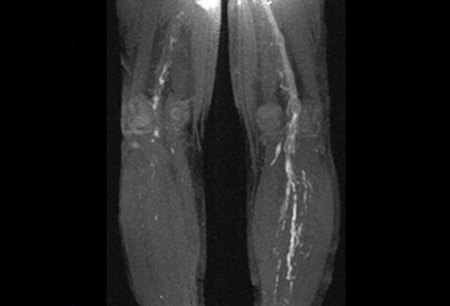 Síndrome antifosfolipídica images