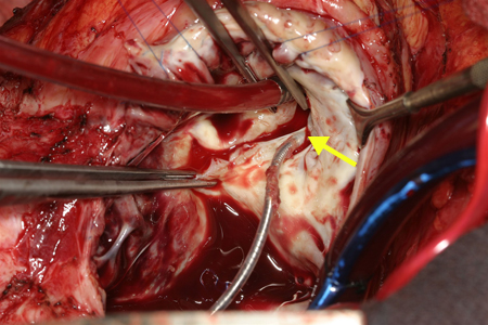 Tricuspid regurgitation images