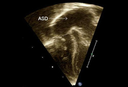 Tricuspid stenosis images