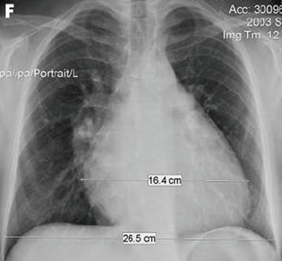 Pulmonary Regurgitation - Diagnosis Approach | BMJ Best Practice