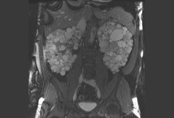 Polycystic kidney disease images