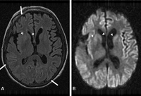 Prion disease