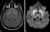 Prion disease