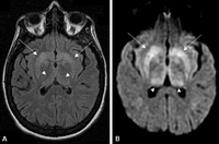 Prion disease