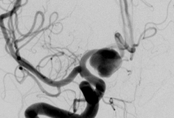 Cerebral aneurysm images