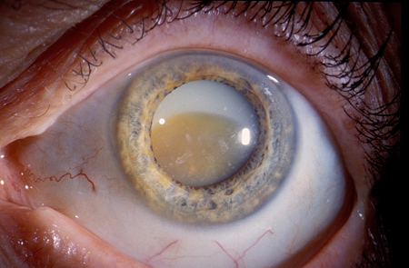 Cataracts images