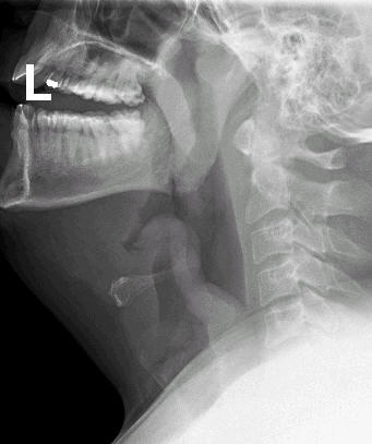 Acute pharyngitis - Differentials | BMJ Best Practice