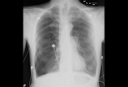 Pneumothorax images