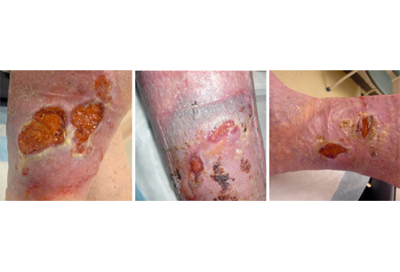 Chronic venous insufficiency images